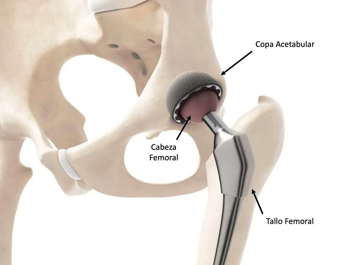 artrosis-de-cadera-protesis