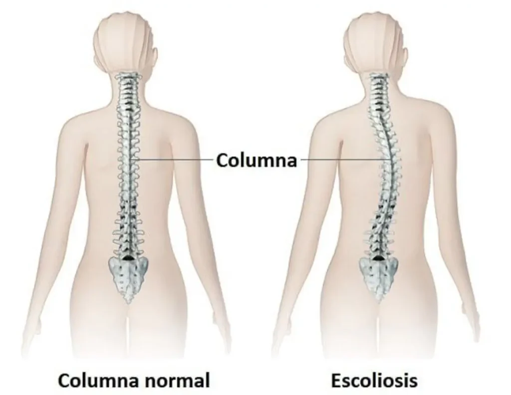 Clínica de Traumatología Quirúrgica | qué es la escoliosis,tipos de escoliosis,síntomas de la escoliosis,escoliosis idiopática,tratamiento de la escoliosis Comparación visual de columna normal y con escoliosis.