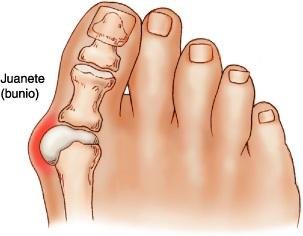 Ilustración de los diferentes tipos de juanetes en los pies - clínica de traumtología quirúrgica