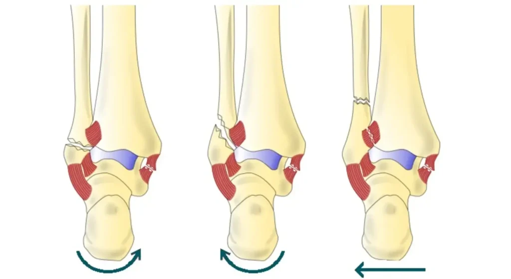 Clínica de Traumatología Quirúrgica | fractura de tobillo,tratamiento de fractura de tobillo,maléolos,tipos de fractura de tobillo,ejercicios para fractura de tobillo Imagen explicativa de los diferentes tipos de fractura de tobillo - Clinica traumotologica quirurjica