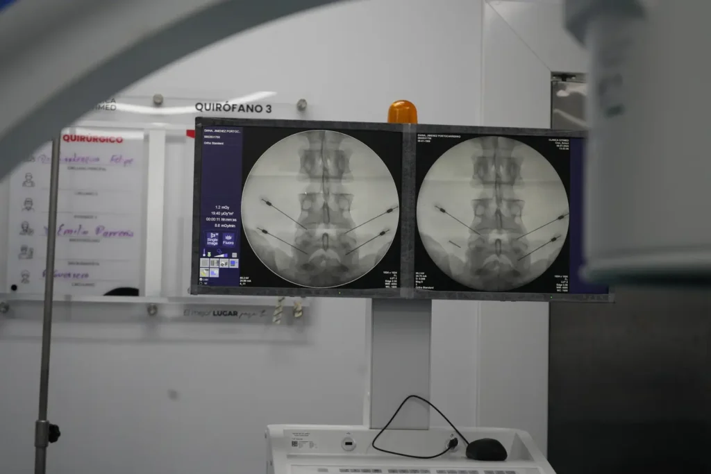 Clínica de Traumatología Quirúrgica | bloqueo foraminal,columna vertebral,bloqueo de columna,dolor lumbar,tratamiento del dolor de espalda Imagen radiológica con aguja dirigida al foramen – Técnica fluoroscópica durante un bloqueo radicular selectivo