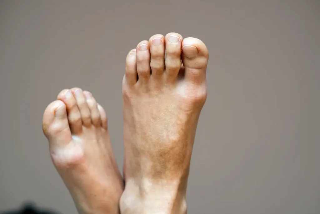 Paciente deportivo con síntomas de juanetes de los pies - clínica de traumtología quirúrgica