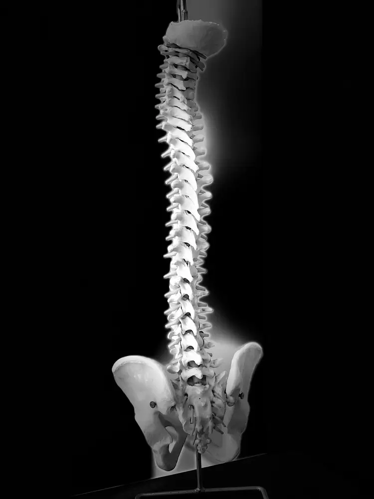 Radiografía mostrando qué es la escoliosis lumbar en su etapa inicial- Clinica traumatologica quirurjica
