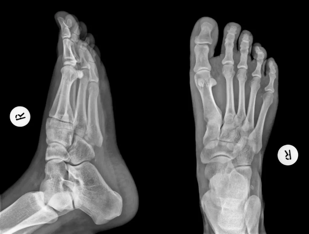 Rayos X de un pie con pie plano severo - clínica de traumatología quirúrgica