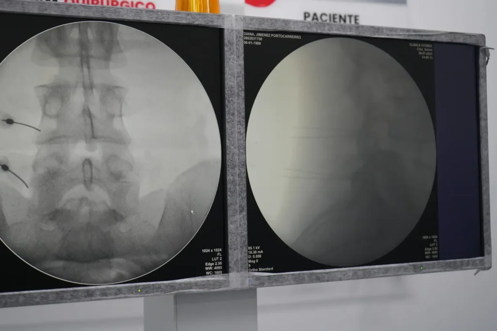 Clínica de Traumatología Quirúrgica | bloqueo foraminal,columna vertebral,bloqueo de columna,dolor lumbar,tratamiento del dolor de espalda imagen radiologica bloqueo foraminal