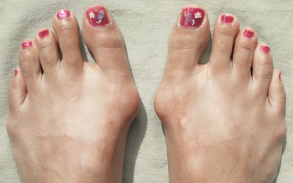juanetes en los pies - clínica de traumtología quirúrgica