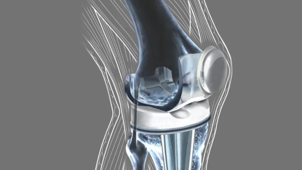 Vista cercana de la protesis de rodilla-clinica de traumatologia quirurgica