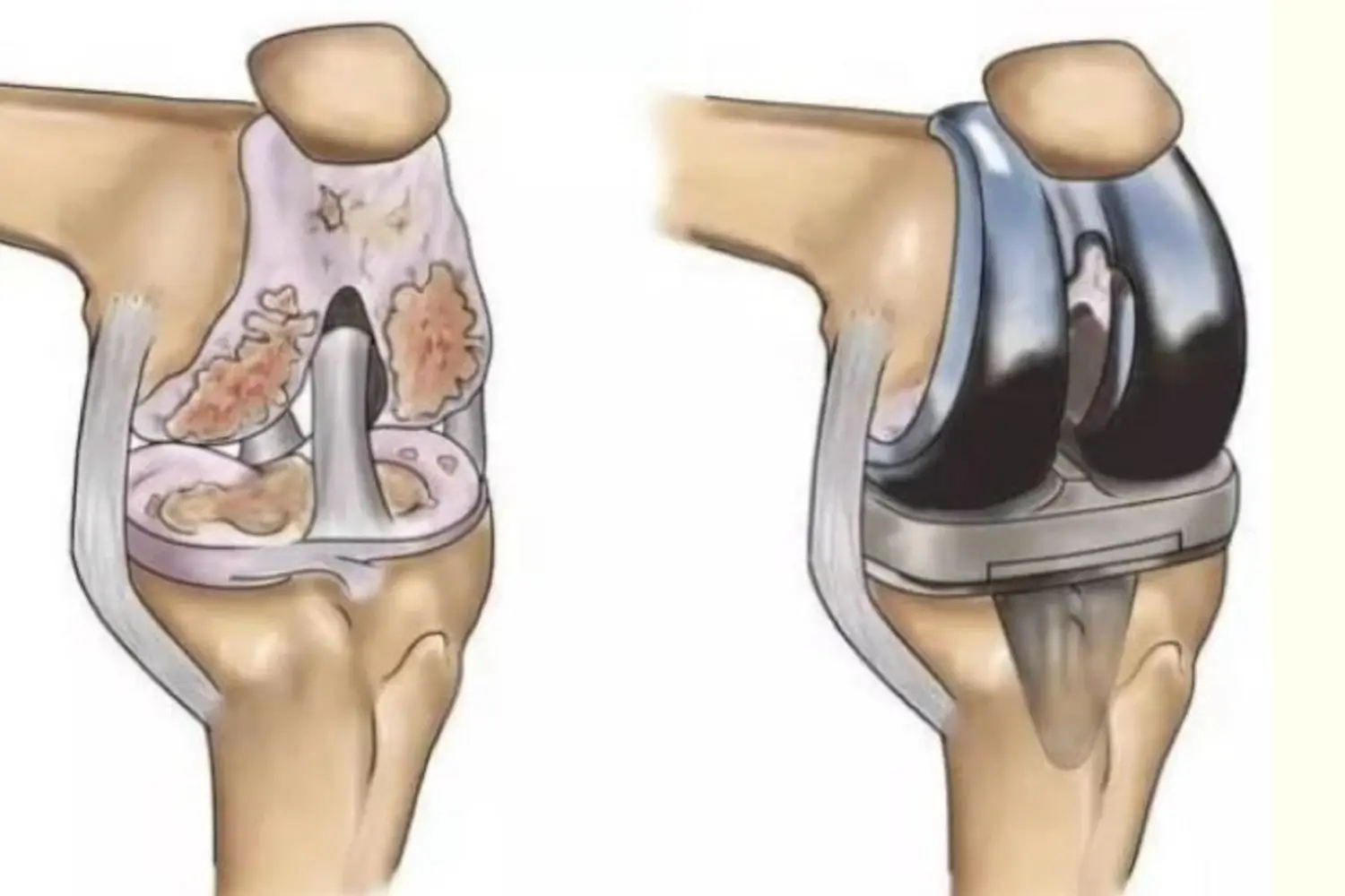 cirugía de prótesis de rodilla con fijación cementada-clinica de traumatologia quirurgica