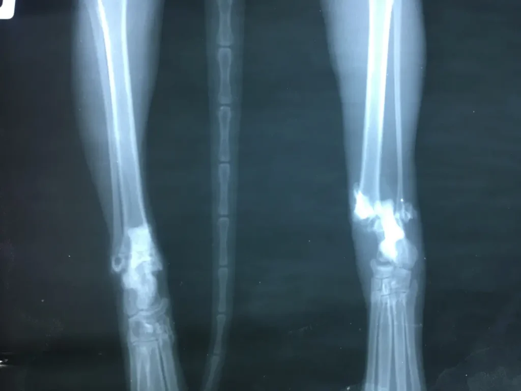 Clínica de Traumatología Quirúrgica | tipos de fracturas,qué tipos de fracturas hay,fractura cerrada,síntomas de una fractura,prevención de fracturas Imagen clínica de una fractura abierta con exposición ósea