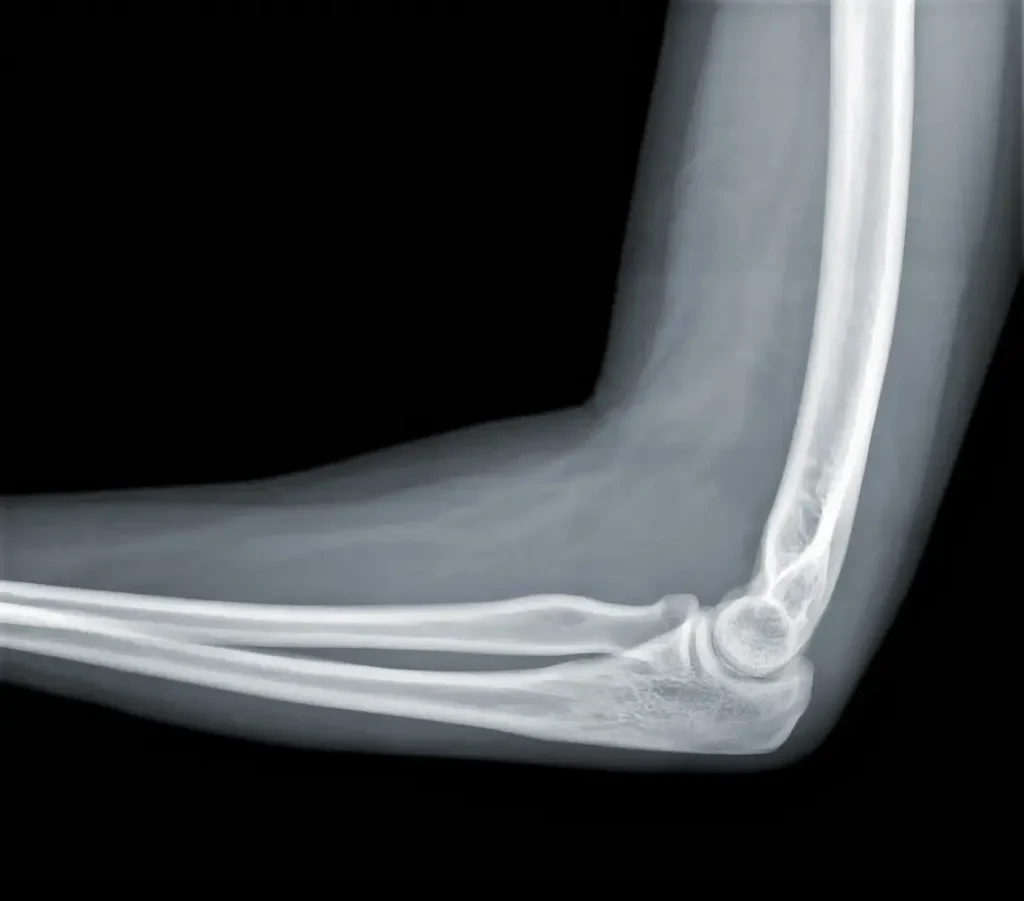 Clínica de Traumatología Quirúrgica | tipos de fracturas,qué tipos de fracturas hay,fractura cerrada,síntomas de una fractura,prevención de fracturas Radiografía mostrando una fractura cerrada en el brazo
