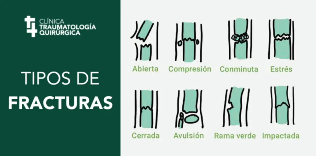TIPOS DE FRACTURAS