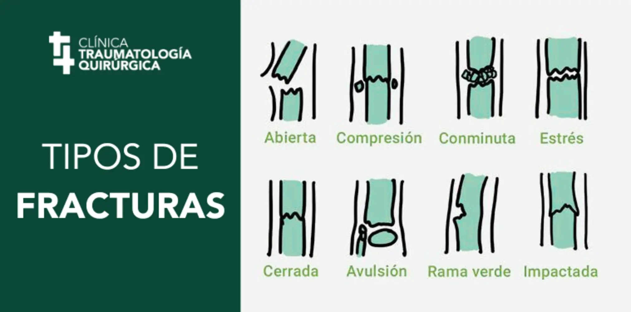 TIPOS DE FRACTURAS