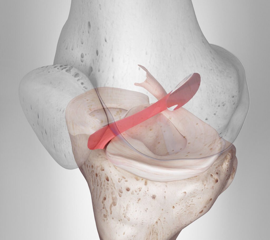 Clínica de Traumatología Quirúrgica | igamento cruzado biológico,reconstrucción LARS,ligamento artificial rodilla,cirugía LCA Quito,ligamento cruzado anterior