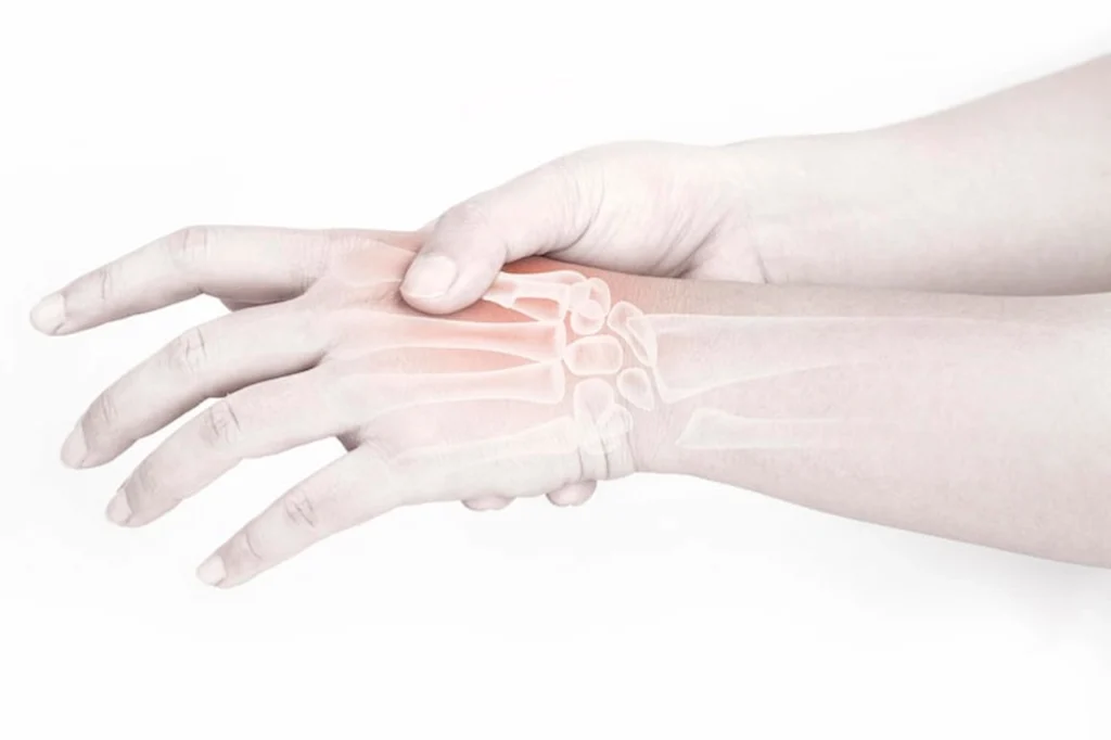 Clínica de Traumatología Quirúrgica | fractura de metacarpiano,fracturas de metacarpianos,fractura de 4to metacarpiano,fractura de 5 metacarpiano,fractura de la mano Radiografía mostrando una fractura de metacarpiano desplazada - clinica de traumatologia quirúrgica