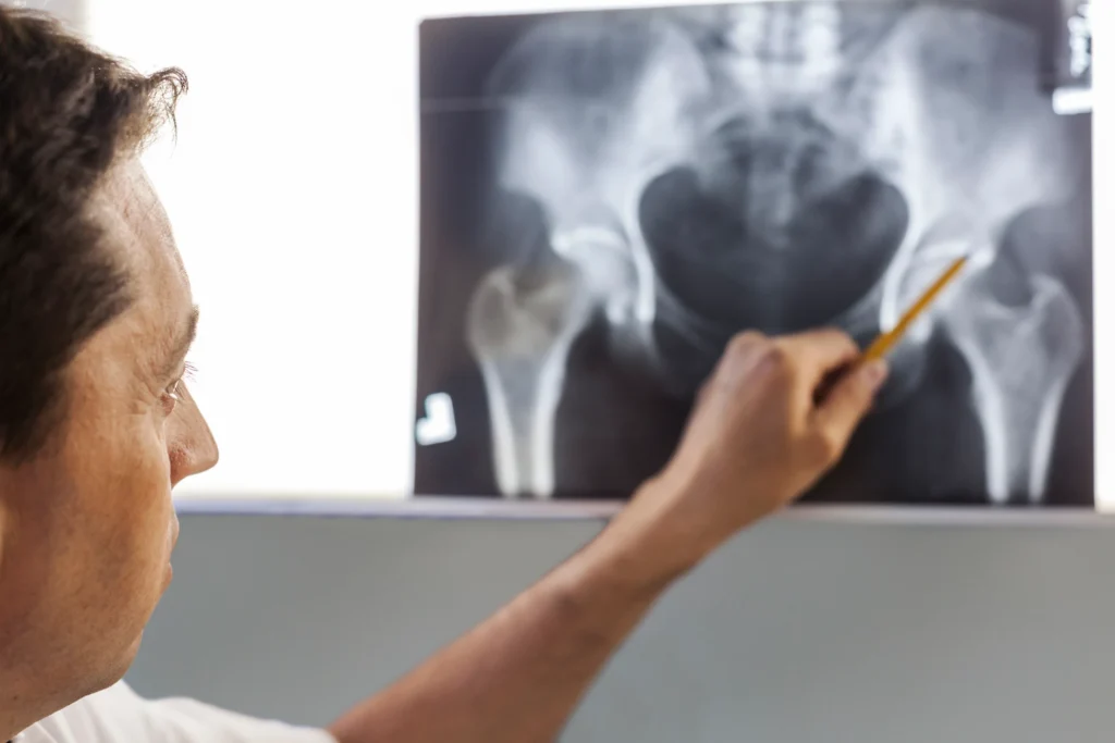 artritis cadera sintomas - Clinica de Traumatología Quirúrgica